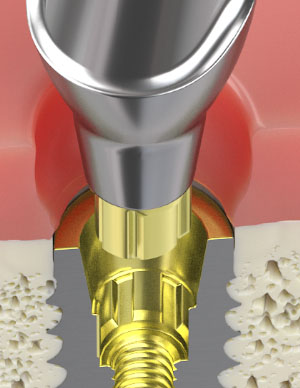 Engaging abutment connection & orientation