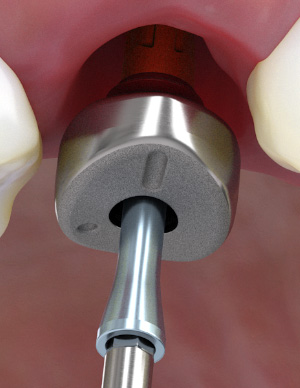 SmartShape™ Healers digital and closed tray impression workflows